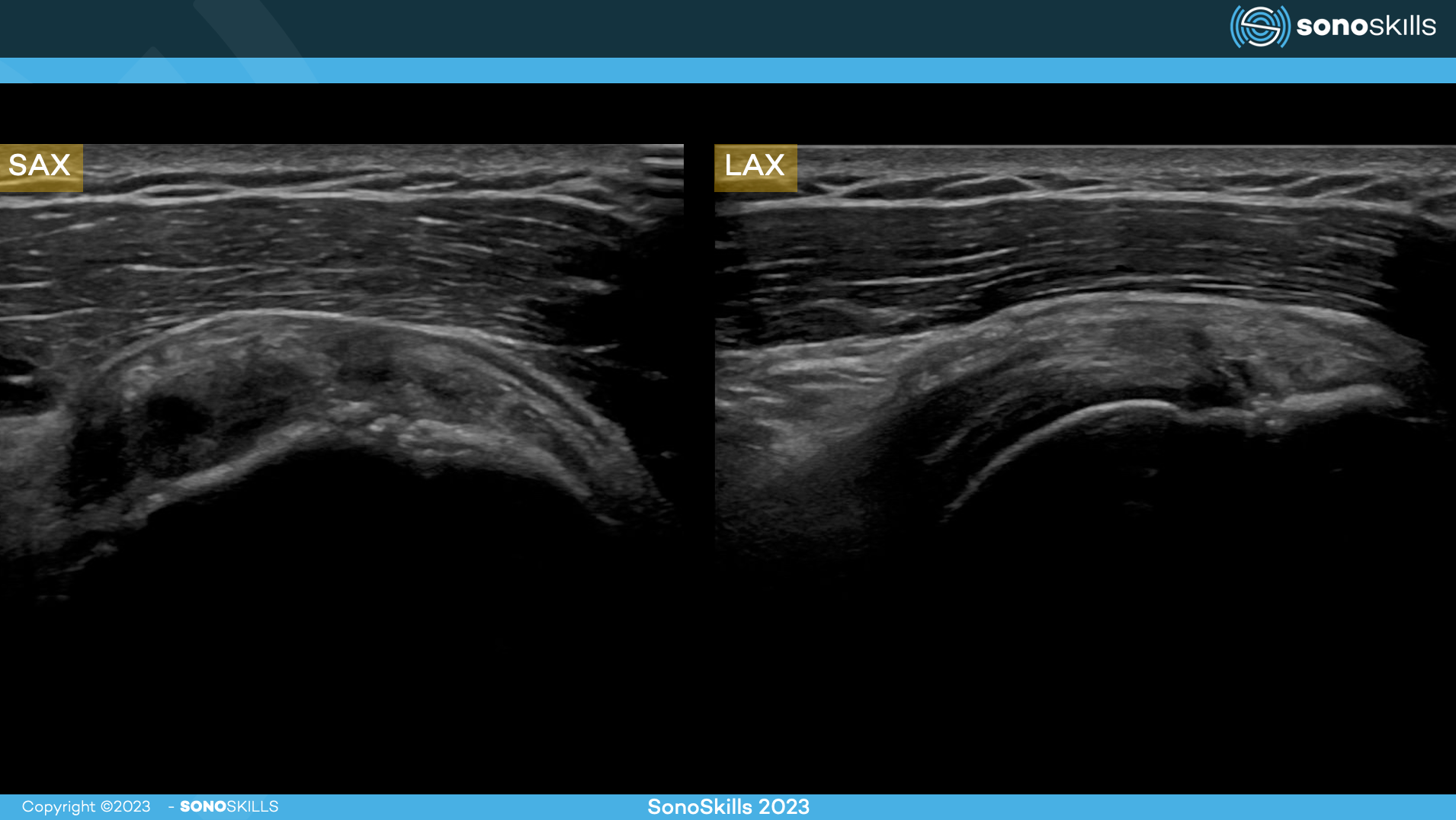 Exploring Soft Tissue Evaluation With Musculoskeletal Ultrasound